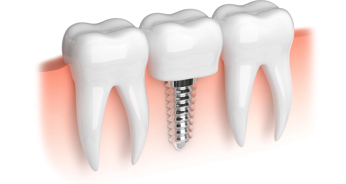 Dental Implants