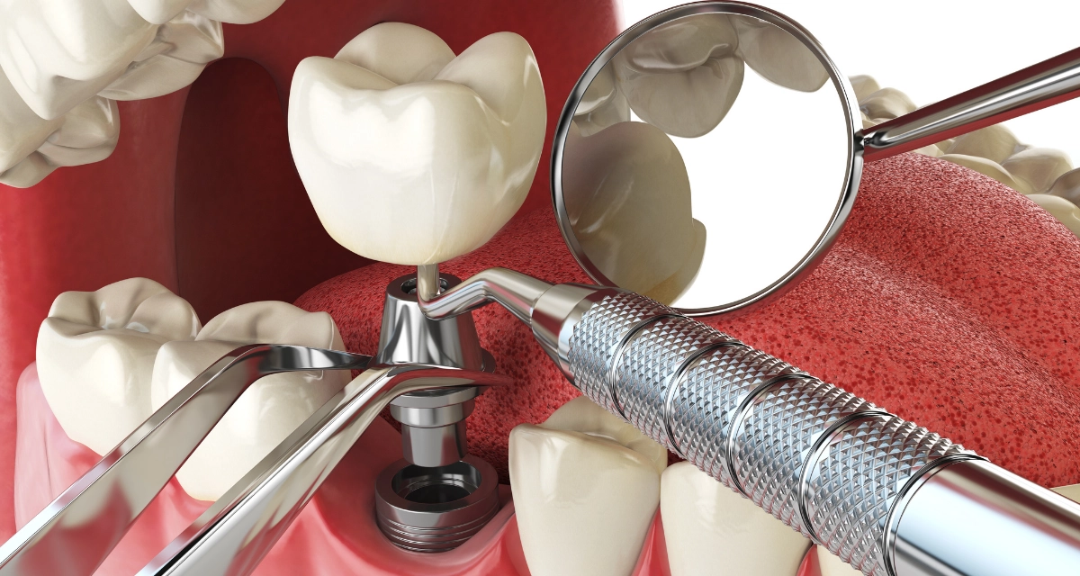Dental Implants
